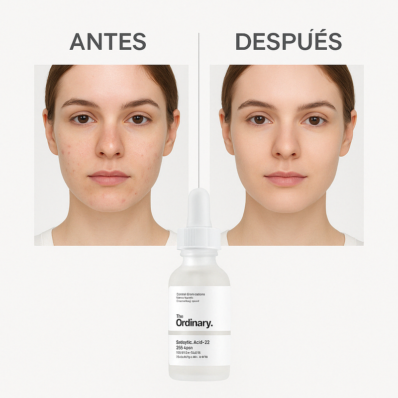 ✨ ¡ADIÓS A LOS GRANITOS Y MANCHAS! CON ACIDO SALICILICO THE ORDINARY ✨